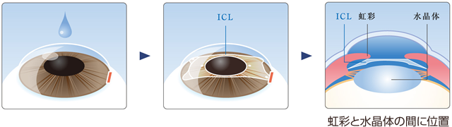 ICLを虹彩と水晶体の間に位置に。