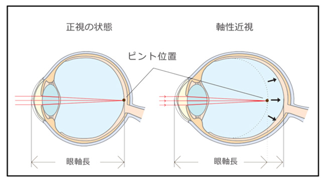 近視　イメージ